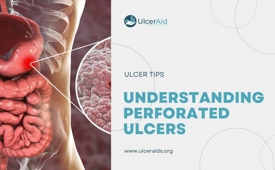 Ulcer Aid,Ulcer Aid Foundation,Ulcers Aids,Ulcer Aids, Home